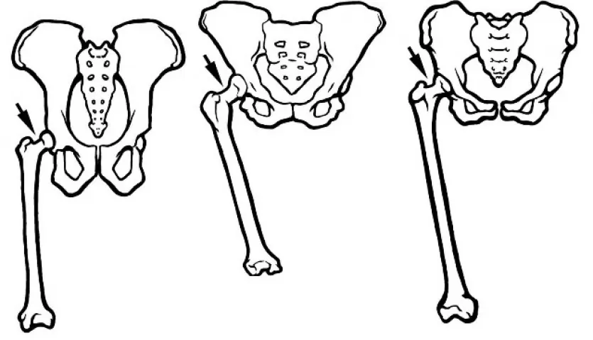 图纸上腿骨的黑猩猩(左),早期人类(中间)和现代人类(右)。
